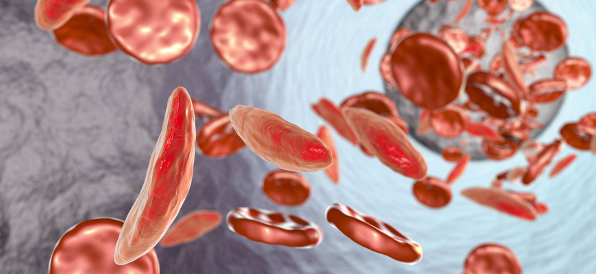 Diagnosis & Treatment of Sickle Cell Anemia